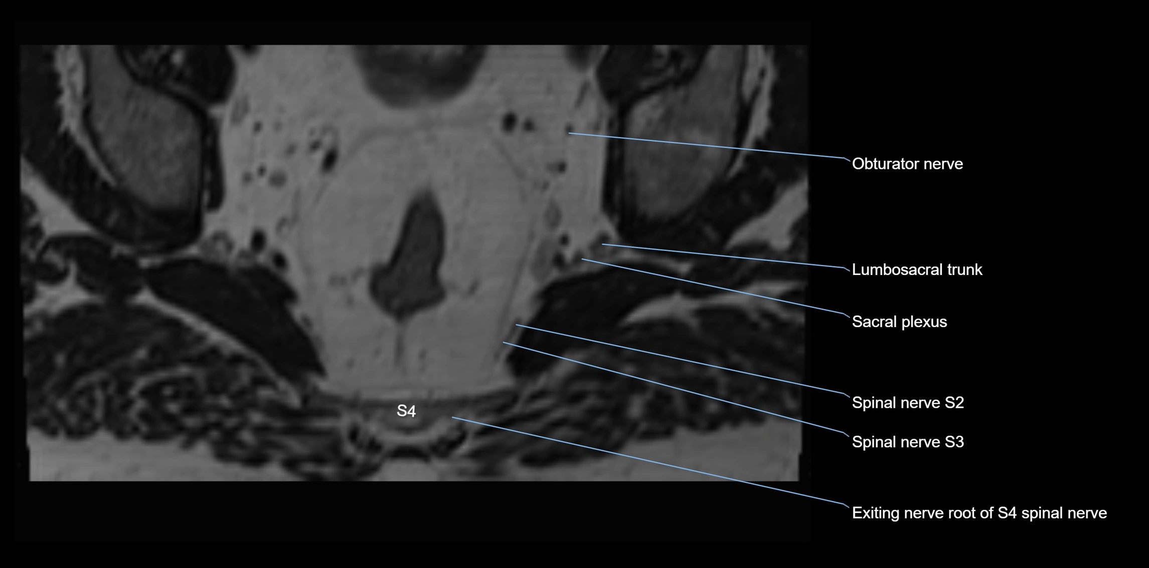 MR lumbosacral plexus axial cross sectional anatomy 3T  radiology  image-img-1008001-00103.webp
